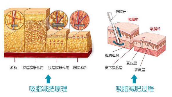 吸脂减肥原理